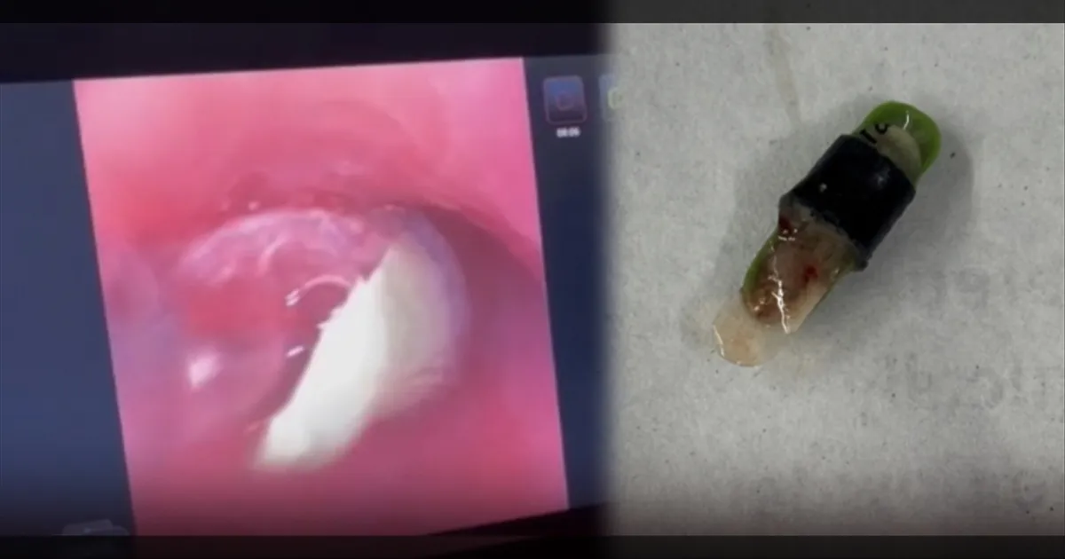 மூச்சு விட்டால் விசில் சத்தம்... குழந்தையை மருத்துவமனைக்கு அழைத்துச் சென்ற பெற்றோருக்கு காத்திருந்த அதிர்ச்சி..!