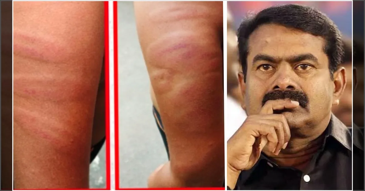 டீச்சரா? மிருகமா? சிறுமியை காட்டுமிராண்டித்தனமாக தாக்கிய தலைமை ஆசிரியர்… சீமான் கடும் கண்டனம்…! 